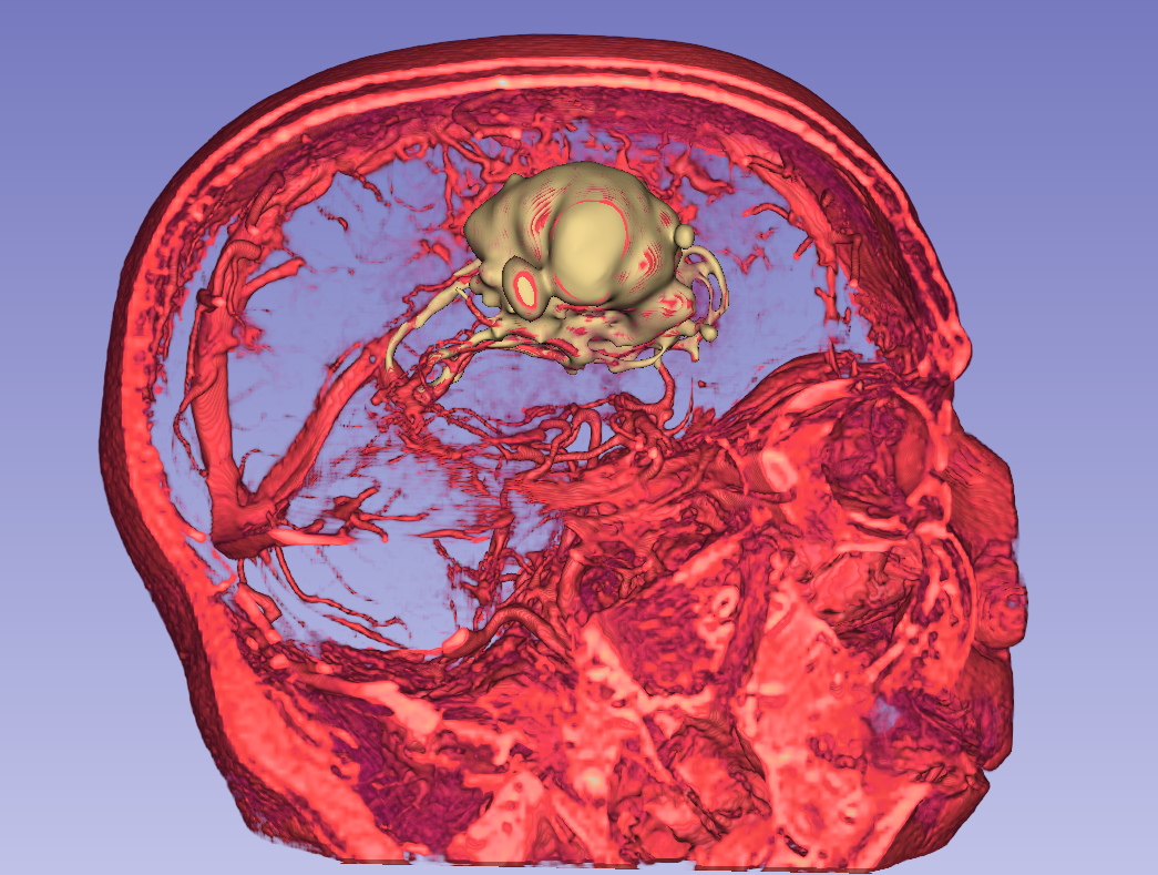 Volume rendering with tumour