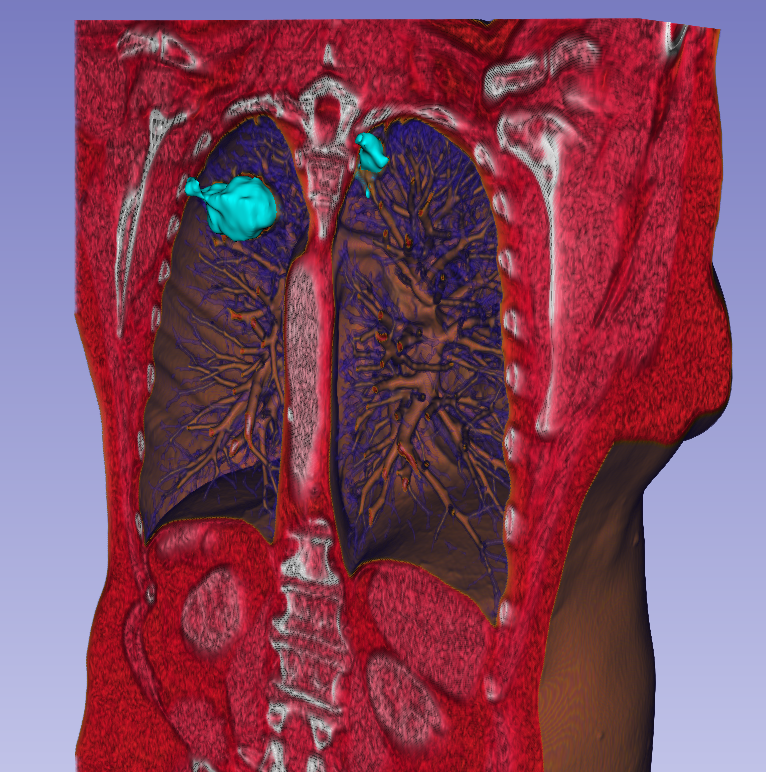 Visualising lung tumors in anatomical context