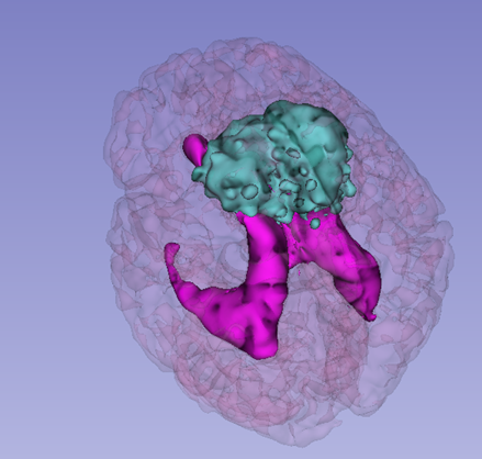 Brain segmentation
