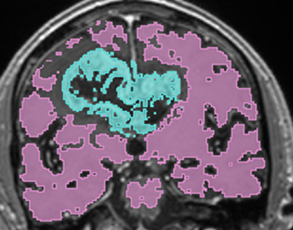 Coronal view of tumour