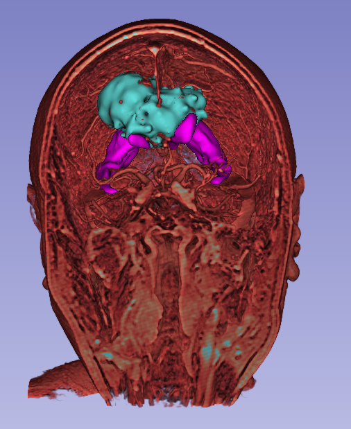 Coronal view of the ventricle