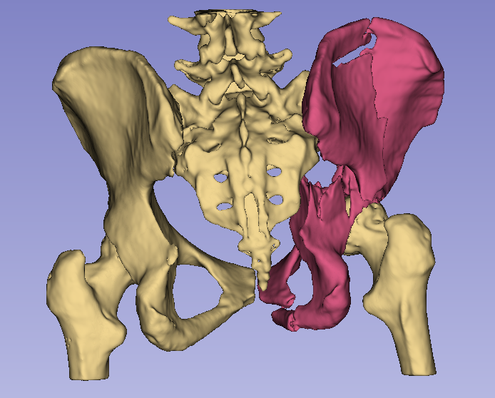 Back view of fractured pelvis segmentation