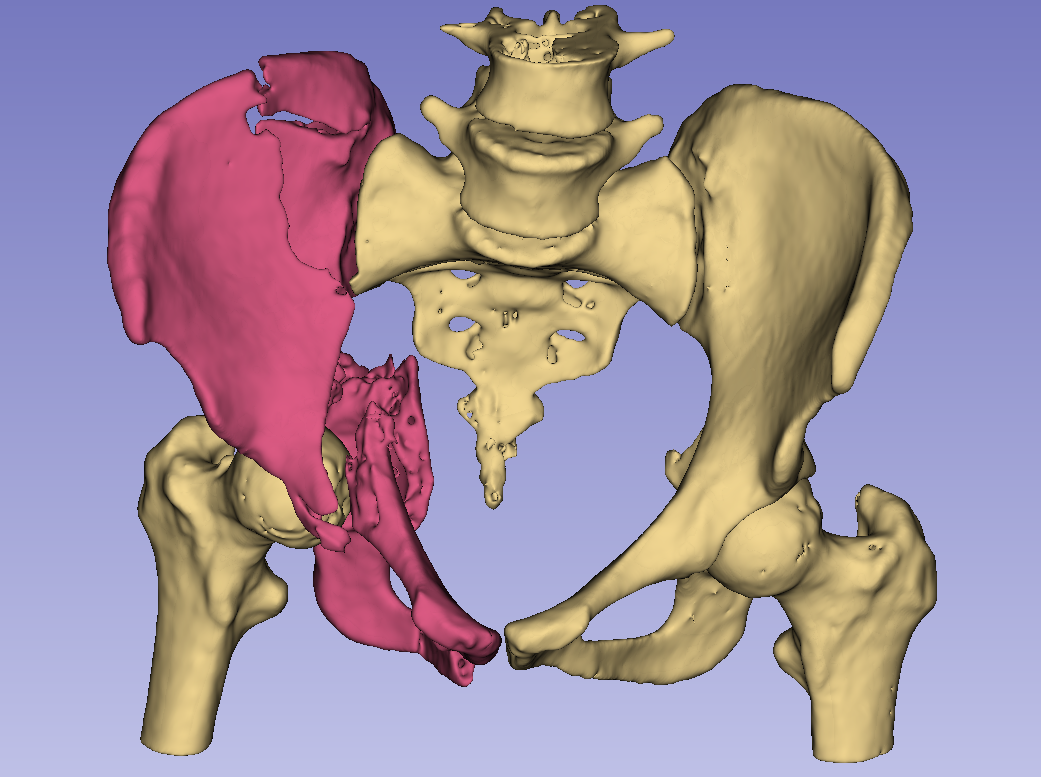 Front view of pelvis segmentation