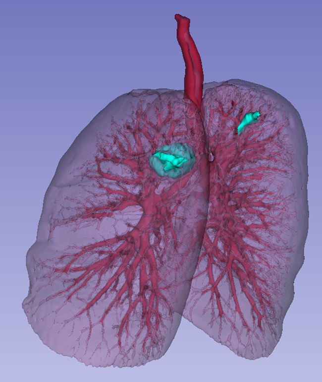 Lungs with trachea segmentation