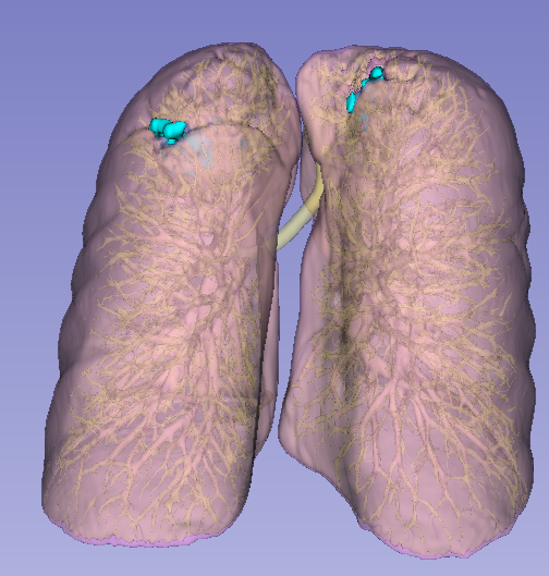 Semi-transparent lung visualisation
