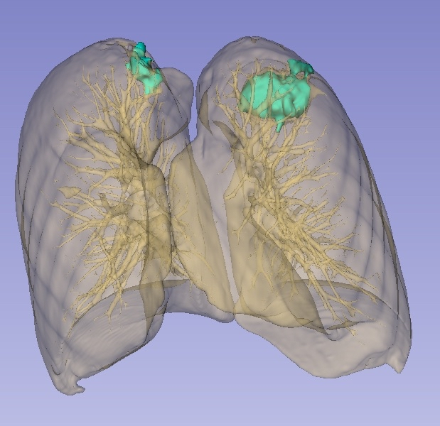 Lung visualisation
