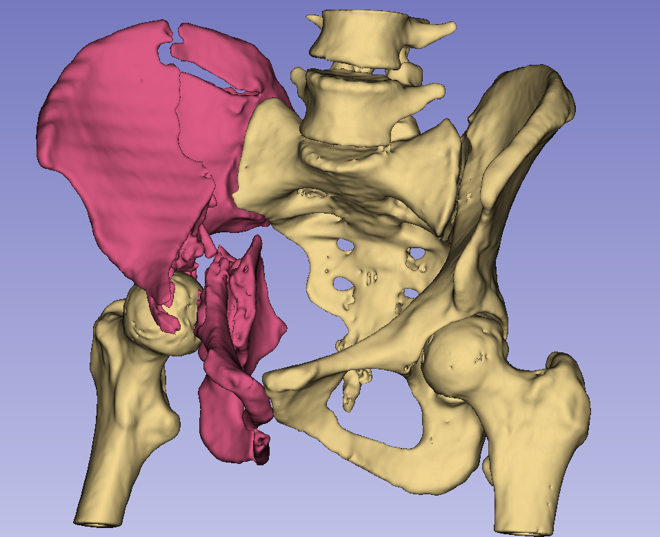 Side view of pelvic fracture