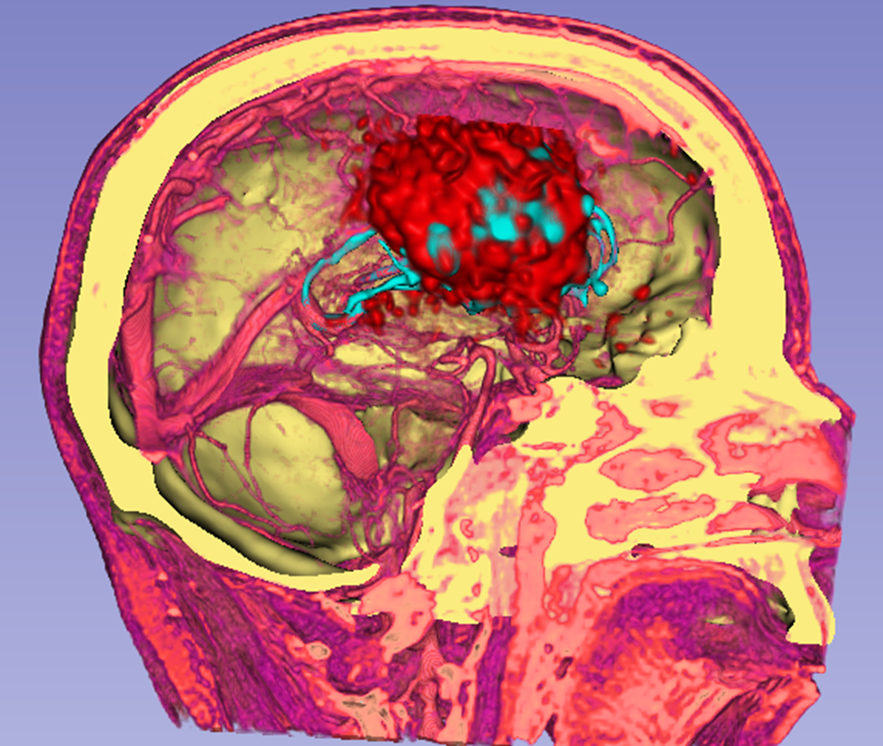 PET, CT and MRI data visualised together.