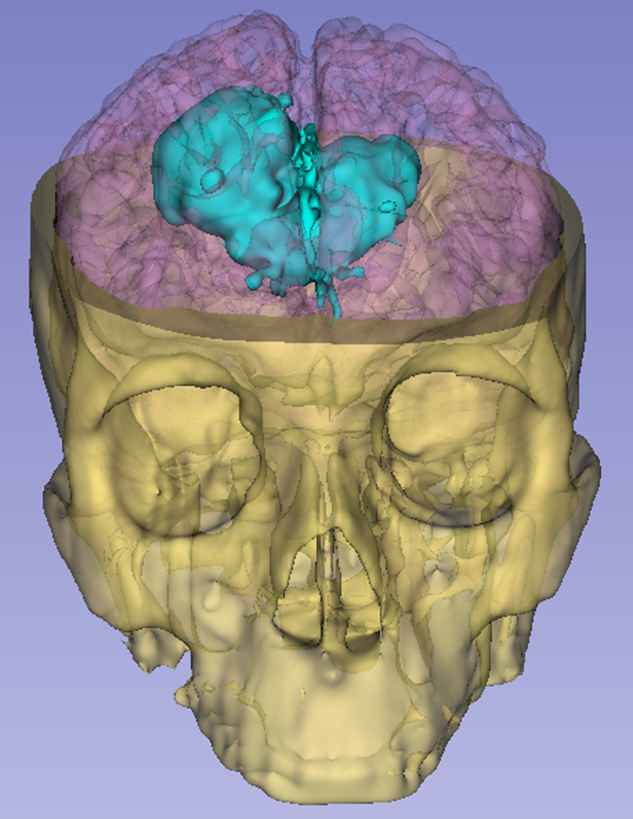 Skull cap segmentation