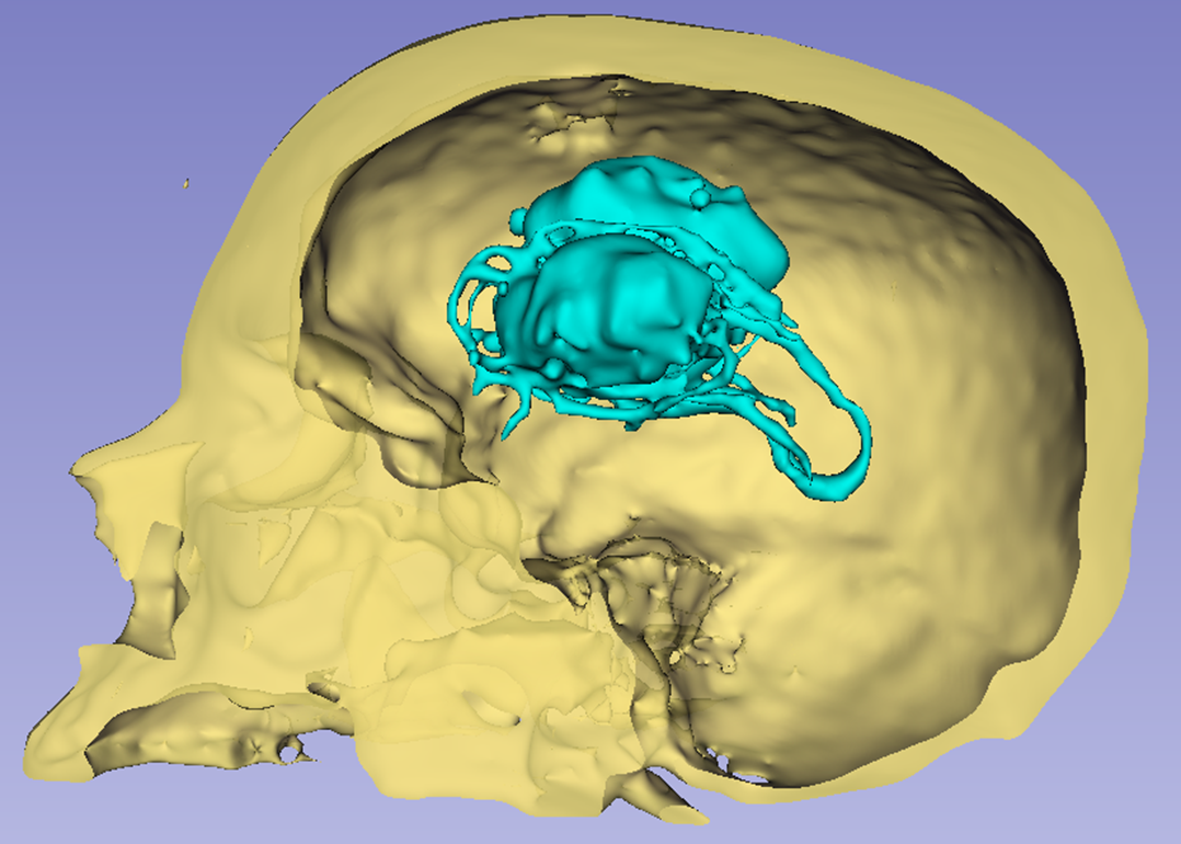 a Sagittal view of the brain tumour