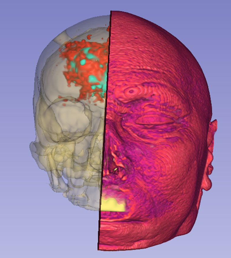 Tumour volume